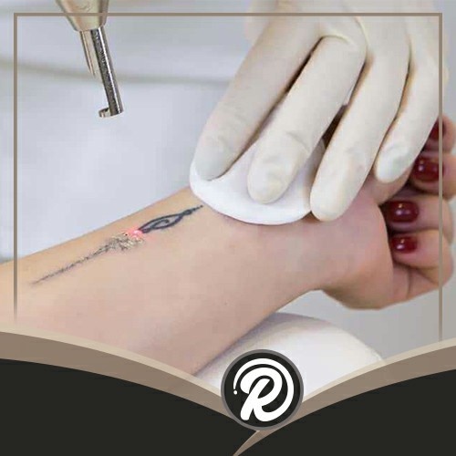 Dövme Silme Denizli